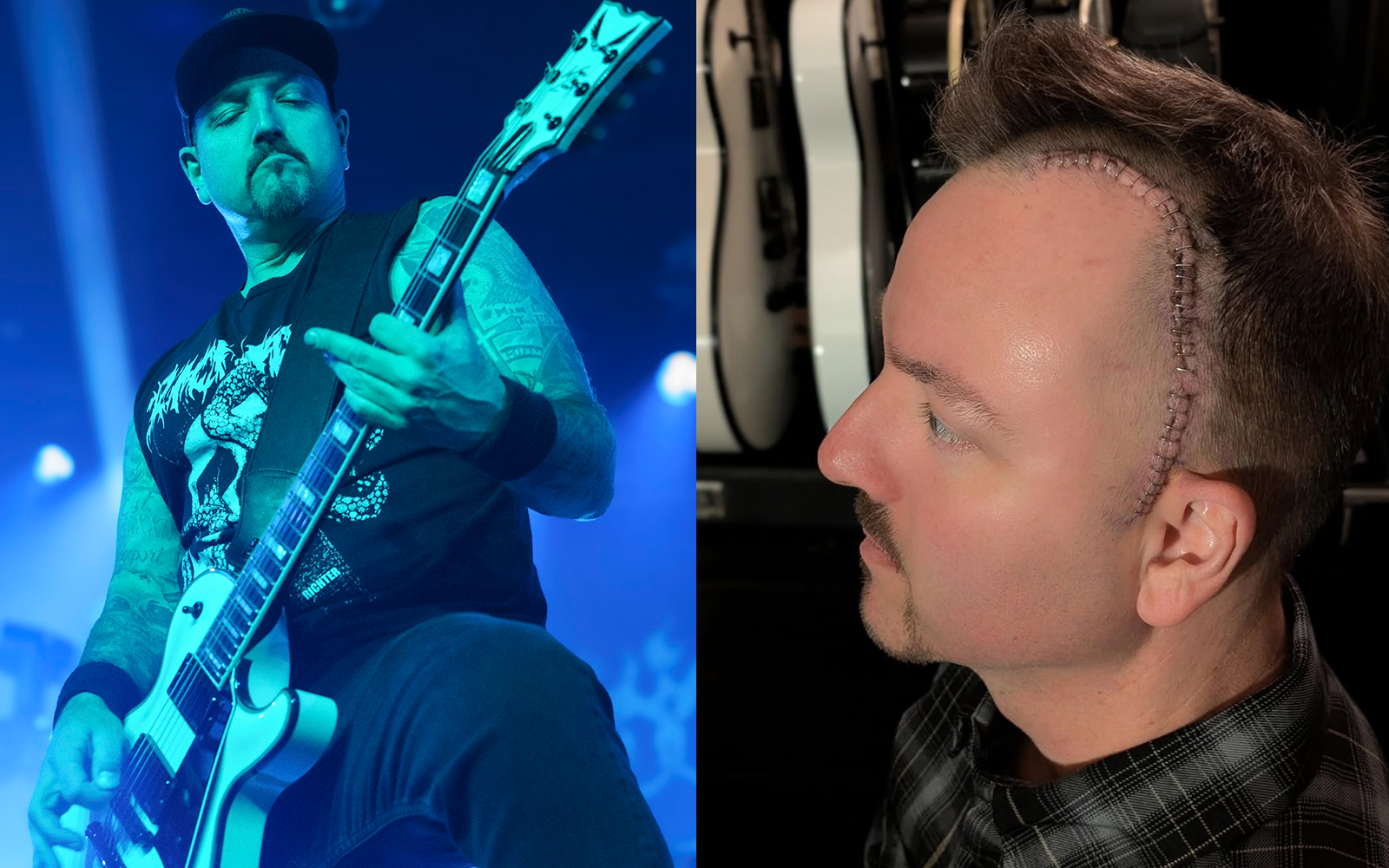 Photo of Hatebreed guitarist Wayne Lozinak after his brain surgery.